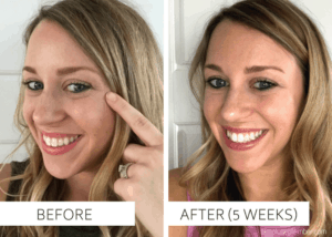 busy mom, loving your skin, RejuvaliteMD, Trophy Skin, before and after pictures