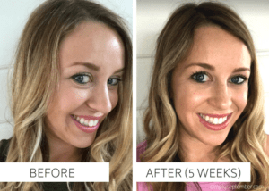 busy mom, loving your skin, RejuvaliteMD, Trophy Skin, before and after pictures